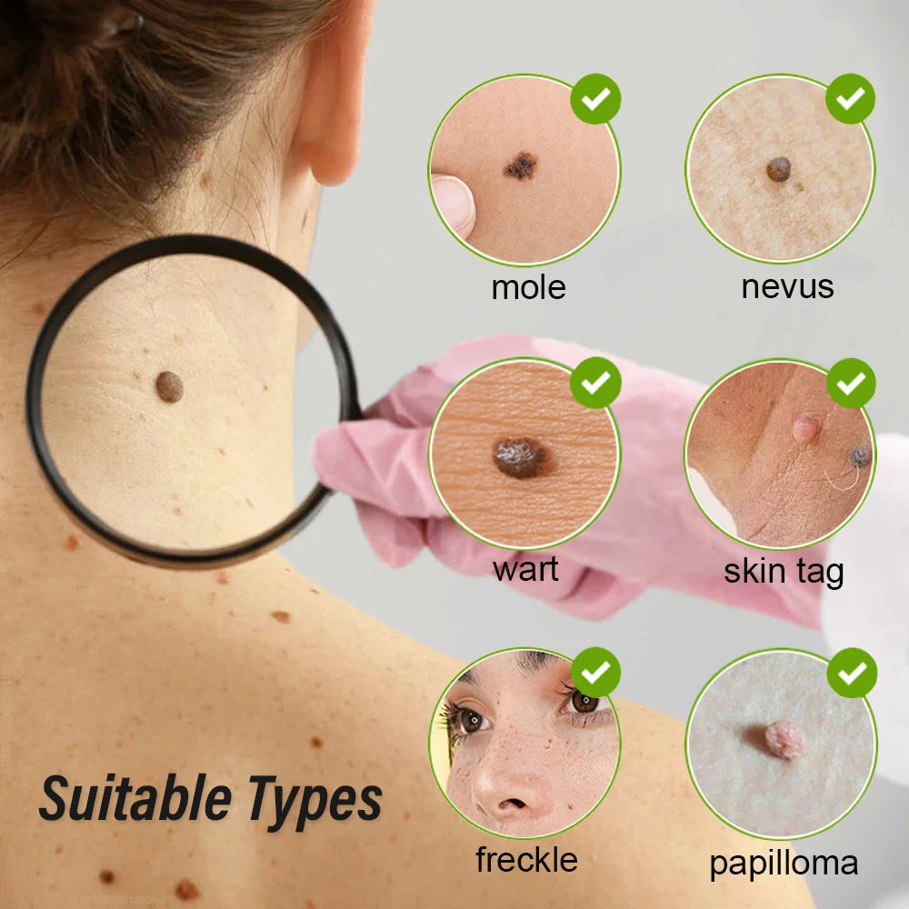 Plasma Pen Mole Warts Removal Dark Spot Black Dot Nevus Freckle Flat Blemish Pimples Remover for Face Body Skin Tag Remover