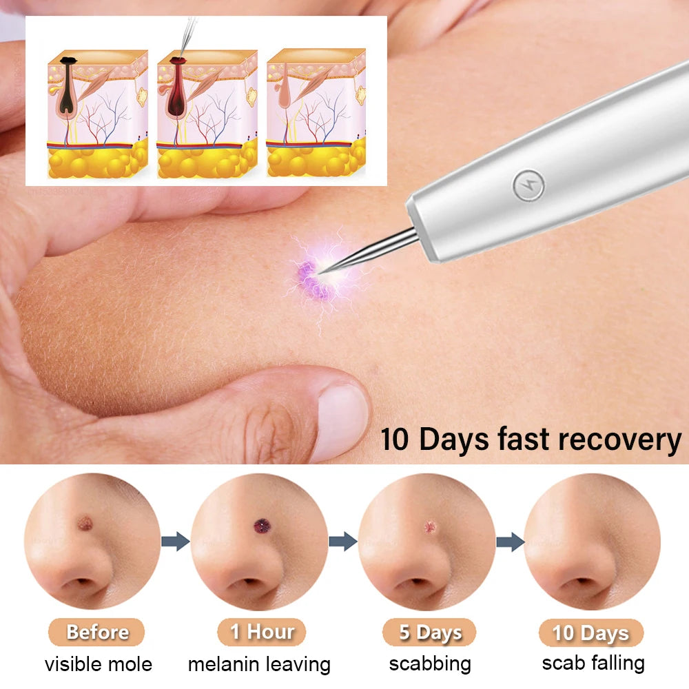 Plasma Pen Mole Warts Removal Dark Spot Black Dot Nevus Freckle Flat Blemish Pimples Remover for Face Body Skin Tag Remover