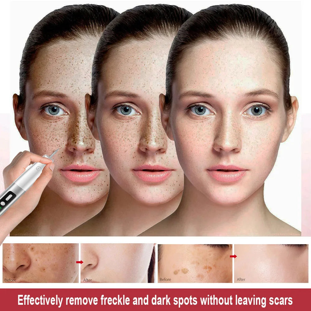 Plasma Pen Mole Warts Removal Dark Spot Black Dot Nevus Freckle Flat Blemish Pimples Remover for Face Body Skin Tag Remover